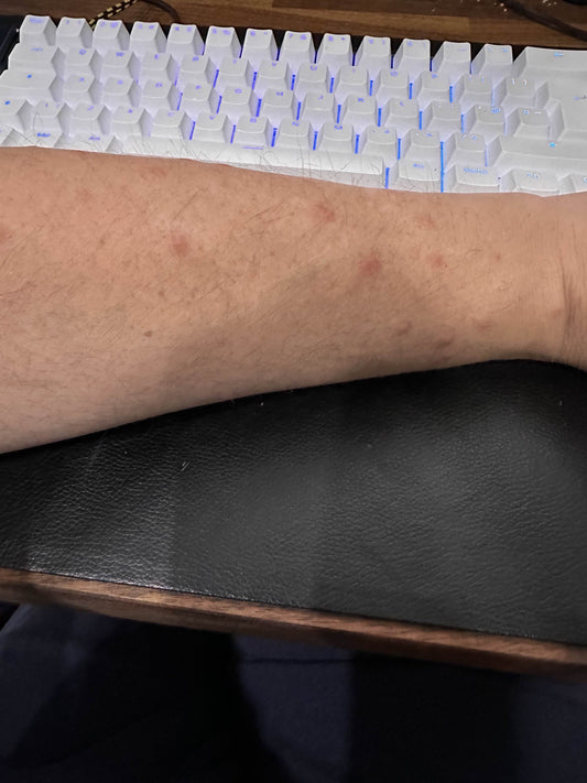 MESHTASTIC BROUGHT ME OUT IN A RASH!!!!!!!